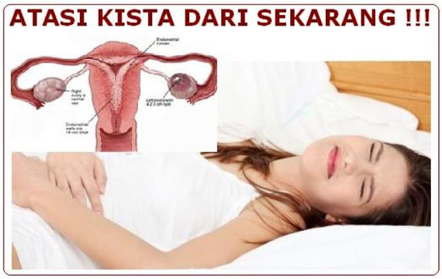 Cara Alami Menyembuhkan Kista Ovarium Tanpa Operasi