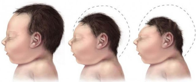 Where Is The Zika Virus ? How to symptoms of zika Where Is The Zika Virus ? How to symptoms of zika