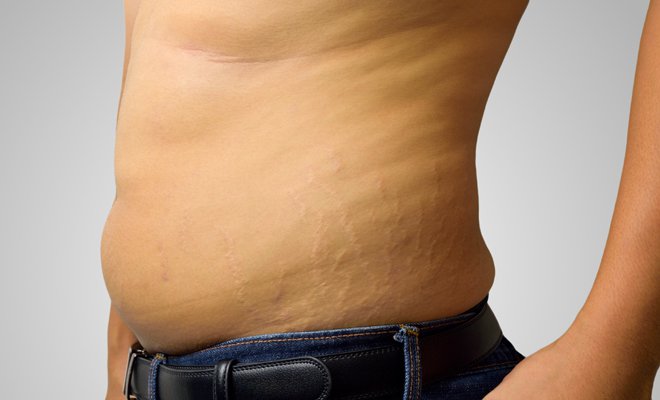 Mejor crema para quitar celulitis Mejor crema para quitar celulitis