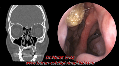 Septum perforasyonu tanımı - Septum perforasyonu nedenleri - Septum perforasyonu belirtileri - Septum perforasyonu tedavisi - Açık teknik septum perforasyonu ameliyatı - Açık teknik septum perforasyonu onarımı - Burun duvarında delik Septum perforasyonu tanımı - Septum perforasyonu nedenleri - Septum perforasyonu belirtileri - Septum perforasyonu tedavisi - Açık teknik septum perforasyonu ameliyatı - Açık teknik septum perforasyonu onarımı - Burun duvarında delik