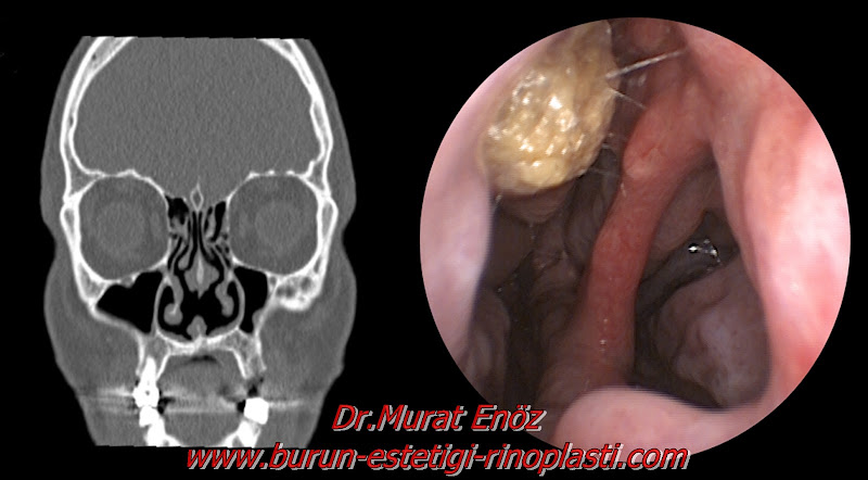 Rinoplasti ve Burun Ucu Estetigi