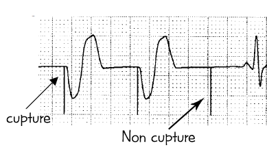 Is Your Transcutaneous Pacemakers Impulse Setting Killing You - 196way3