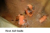 Severe burns and scalds--First Aid Guide Severe burns and scalds