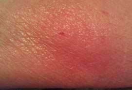 Chiggers: Bites, Treatment & How to Get Rid of Chiggers