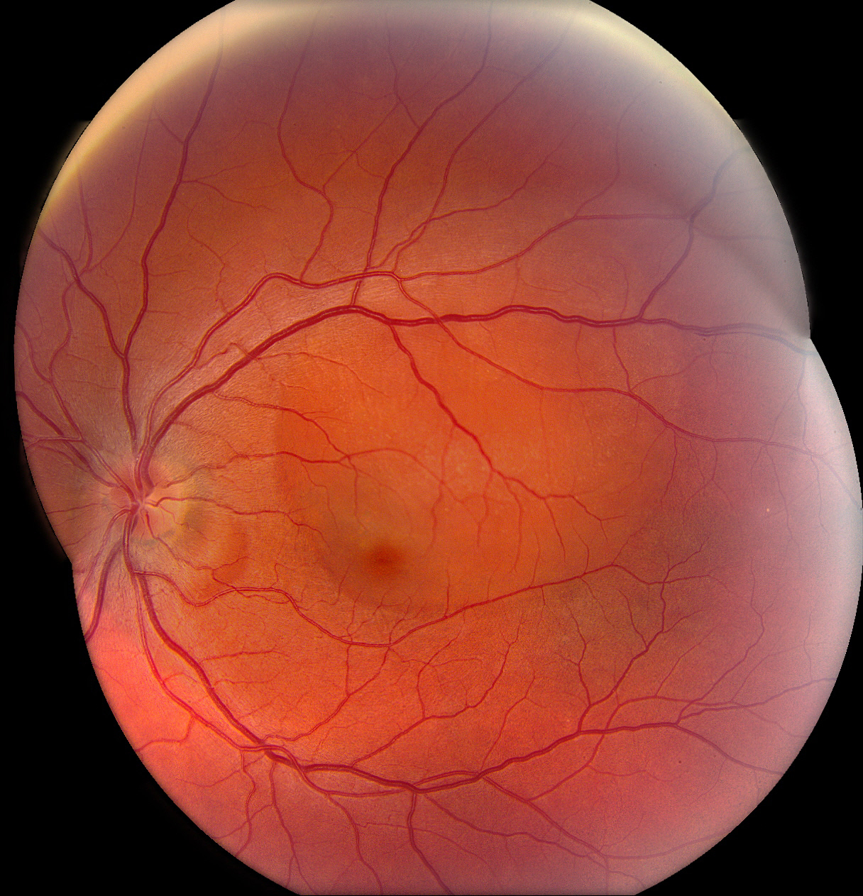Ангиопатия сосудов головного. Непролиферативная диабетическая ретинопатия. Геморрагическая ретинопатия. Ретинопатия клофазимина. Атеросклеротическая ретинопатия.