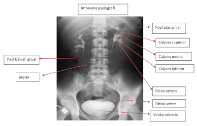 Dasar-Dasar Radiologi : Foto BNO-IVP