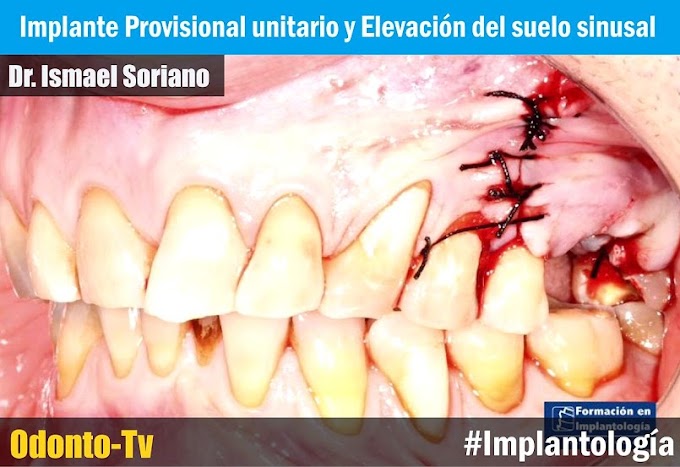 IMPLANTE DENTAL Provisional unitario y Elevación del suelo sinusal - Dr. Ismael Soriano