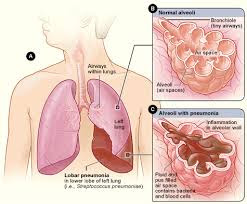 Image result for paru paru kolesterol