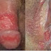 Jual Obat Sipilis