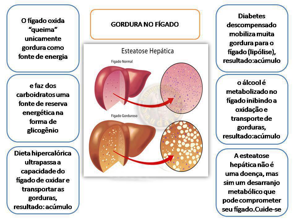 Esteatose hepática Nutricionista Andréa Paes de Barros Queiroz Esteatose hepática Nutricionista Andréa Paes de Barros Queiroz