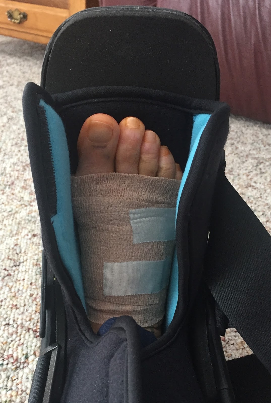 Before, During, & After Bunion Surgery... Four Weeks PostOp [second