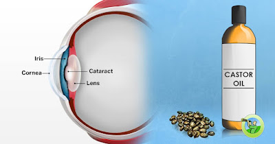 Castor Oil Drops As A Cure For Cataracts Castor Oil Drops As A Cure For Cataracts