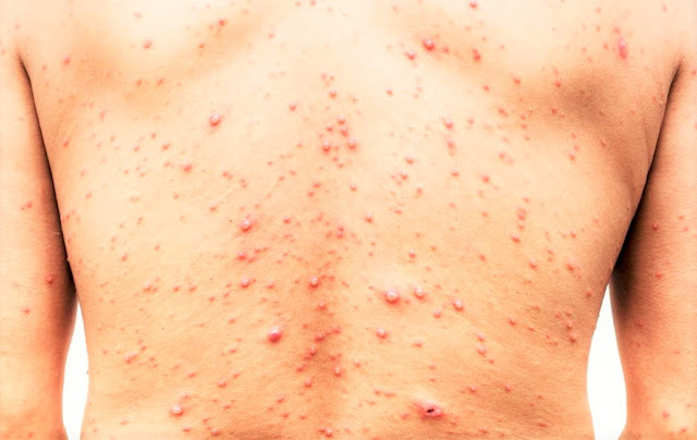 Chicken Pox Chicken Pox