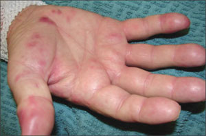 osler s nodes pictures definition symptoms causes treatment