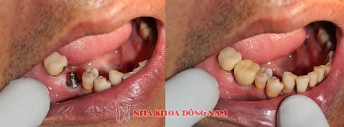 CẤY GHÉP IMPLANT PHỤC HÌNH RĂNG HÀM BỊ MẤT