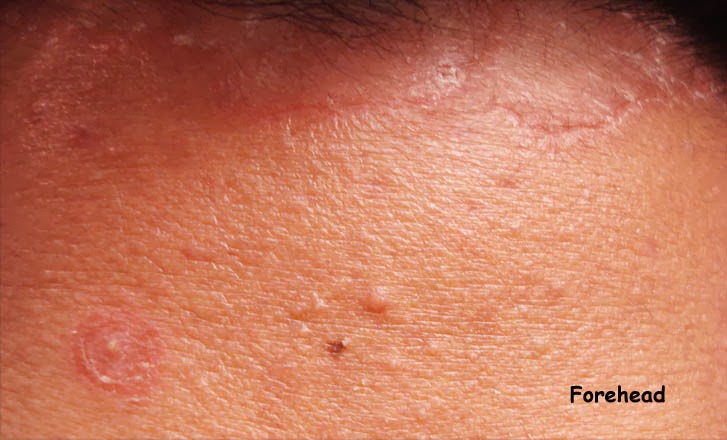 VIRTUAL GRAND ROUNDS IN DERMATOLOGY 2.0: Arcuate and Circinate Facial ...