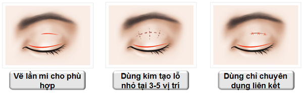 Nhấn mí bằng chỉ Nhấn mí bằng chỉ