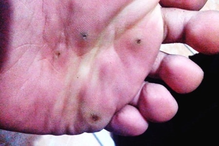 Kutil plantar Kutil plantar
