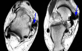 MRI Musculo-Skeletal Section: Spring complex ligament.