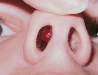 Cara Menghilangkan Benjolan di Dalam Hidung Tanpa Operasi Cara Menghilangkan Benjolan di Dalam Hidung Tanpa Operasi