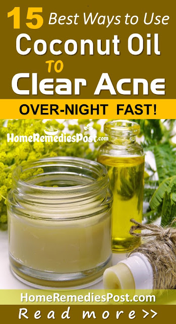 How To Use Coconut Oil To Clear Your Acne Overnight Fast Coconut Oil For Acne, Coconut Oil Acne, Coconut Oil And Acne, Is Coconut Oil Good For Acne, How To Use Coconut Oil For Acne, How To Get Rid Of Acne, How To Get Rid Of Acne Fast, Home Remedies For Acne, Acne Treatment, How To Cure Acne, Acne Home Remedies, How To Cure Acne Fast, Acne Remedies, Home Remedies For Acne Treatment, Easy Acne Treatment, Acne Treatment, How To Treat Acne Fast