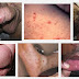 Obat Sipilis Pria thumbnail