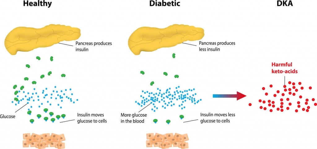 Diabetic-Ketoacidosis-DKA