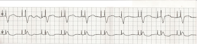 EKG Rhythm Strip Quiz 43
