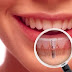 Trồng răng implant giá khoảng bao nhiêu tiền ?