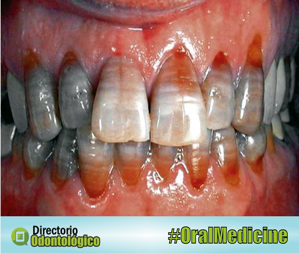 Tetracycline Stained Teeth Causes