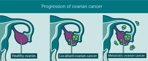 Ο καρκίνος των ωοθηκών, προκαλεί πόνο, πρήξιμο χαμηλά στην κοιλιά, αίσθημα φουσκώματος, αύξηση βάρους, κούραση Progression_ovarianCancer1