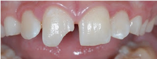 Prix pour réparé une dent cassé Coût de réparation des dents ébréchées