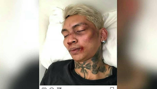 Young Lex berantem wajah bonyok