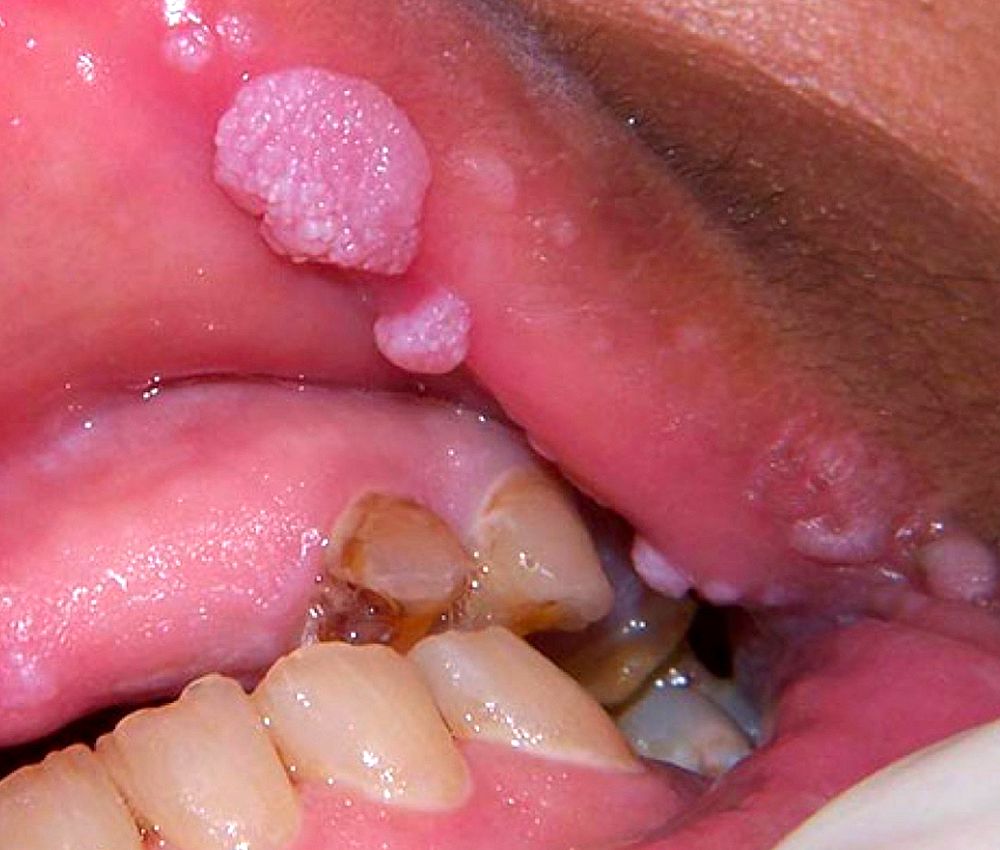 Oral-HPV