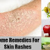 3 Best Natural Remedies For Rashes