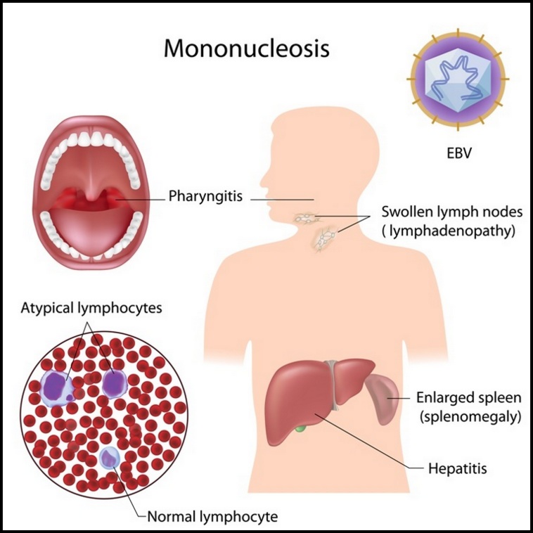 Mononucleosis disease