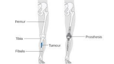 bone cancer