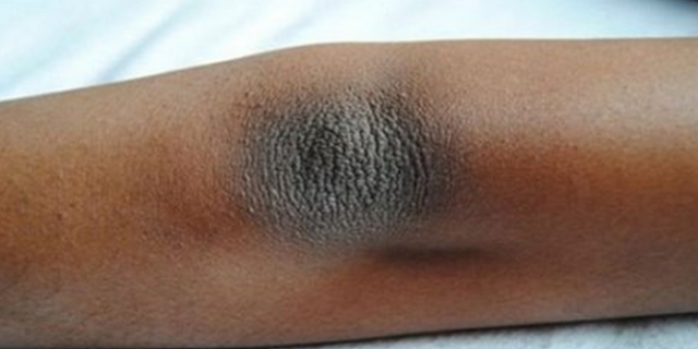 3 Tips Praktis Menghapus Kulit Kering dan Warna Gelap di Siku dan Lutut