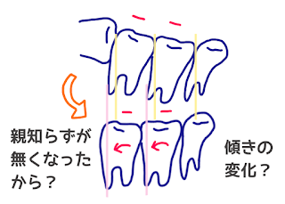 ©さんがつの歯科矯正を始めます　歯科矯正のイラスト