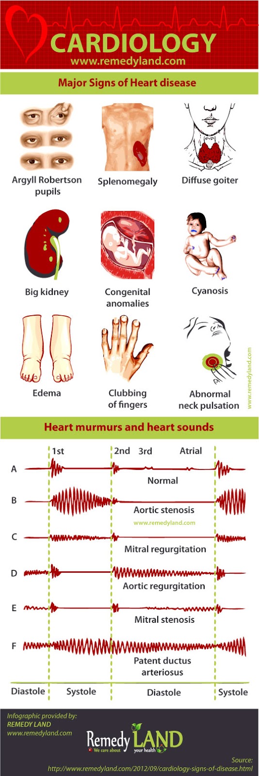 signs of heart disease: Argyll Robertson pupils, splenomegaly, diffuse goiter, a big kidney, congenital anomalies, abnormal venous pulsation in the neck, cyanosis, edema, clubbing of fingers, heart murmurs and heart sounds
