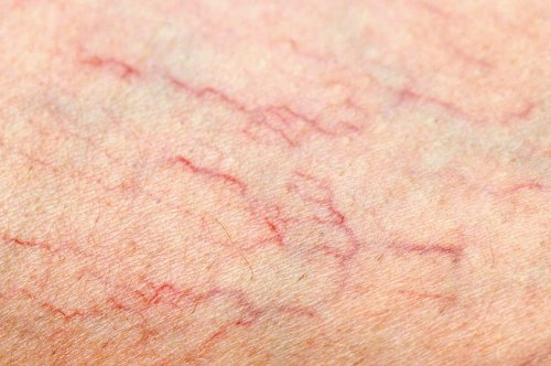 Réduire l'inflammation et les varices Réduire l'inflammation et les varices