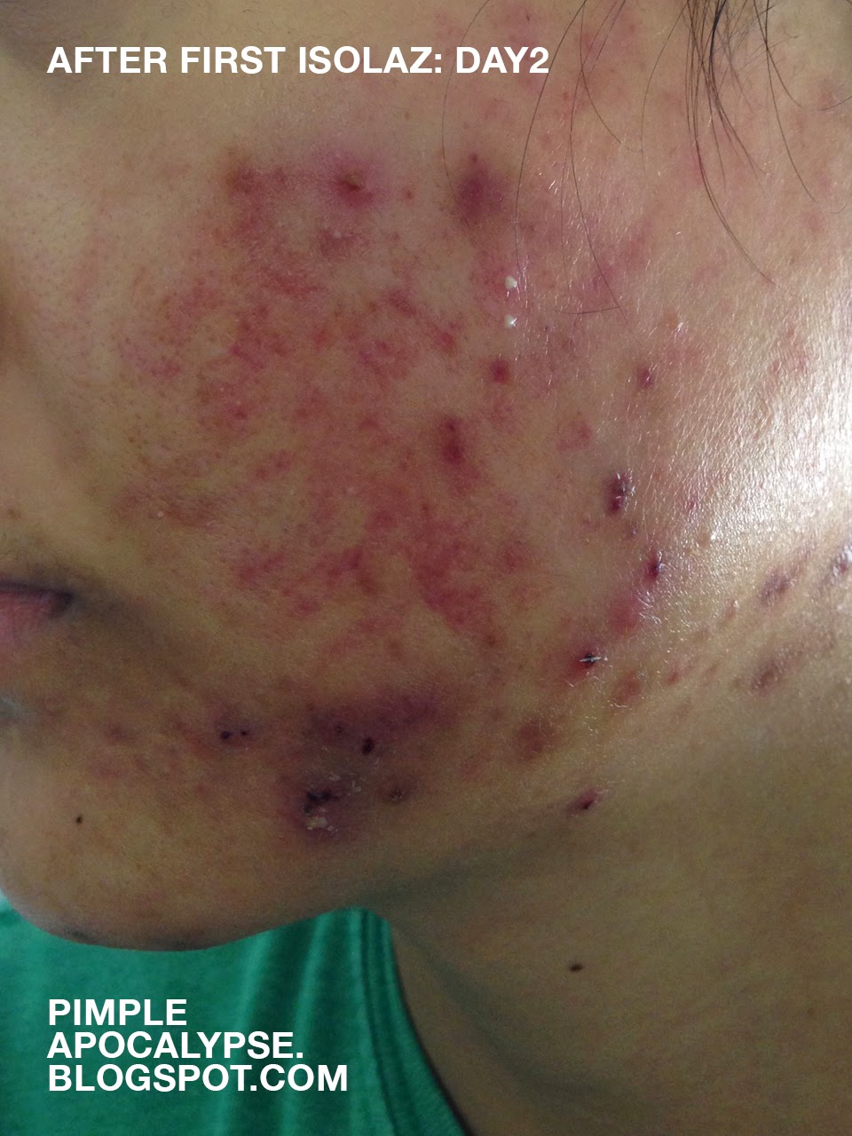 pimple apocalypse My experience with Isolaz and Laser Genesis (still