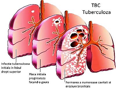 de ce pierderea în greutate are loc în tuberculoză)