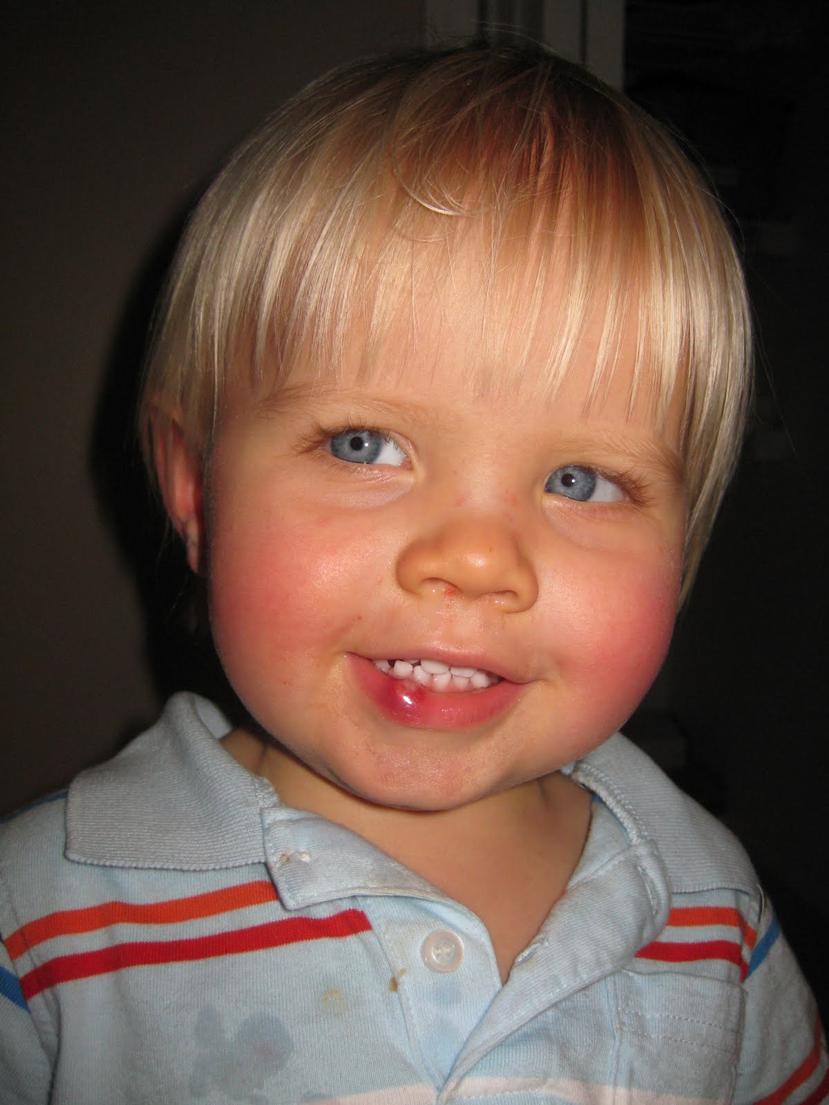 Katz Kidz Busted lip and still smiling!