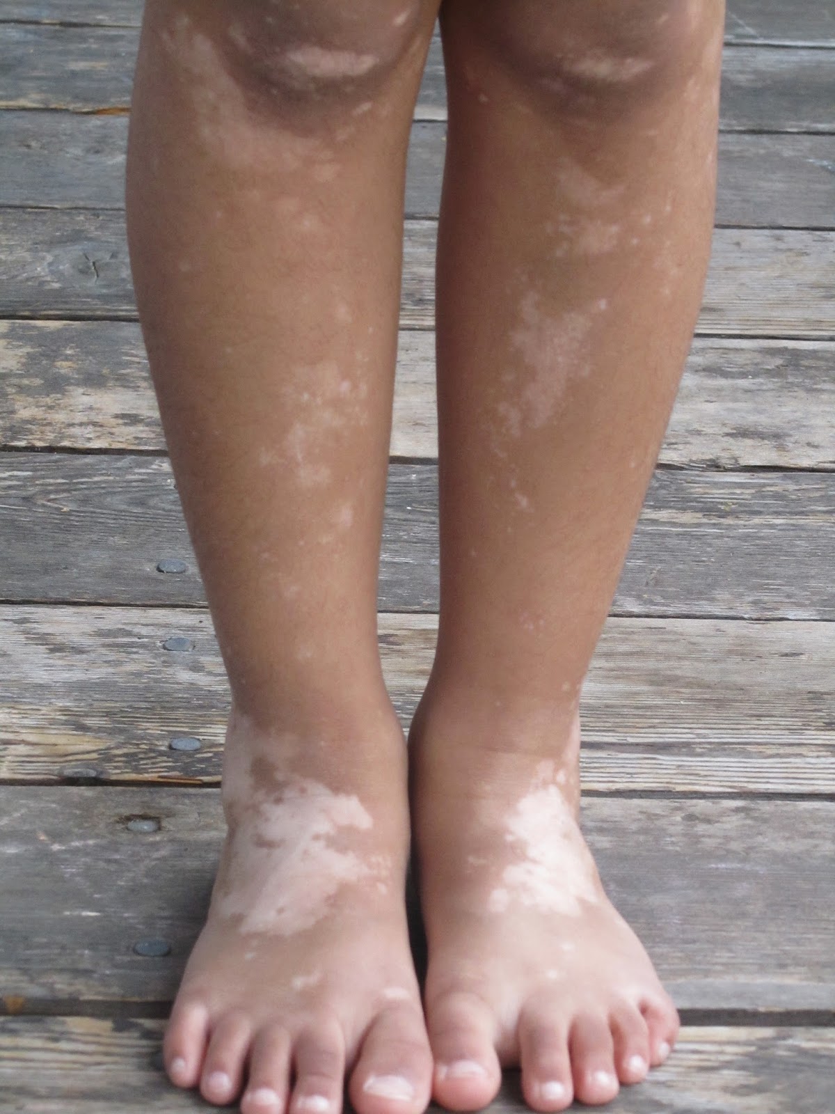  Leucoderma - Vitiligo   What is Leucoderma - Vitiligo? Lecucoderma, also known as vitiligo, is a distressing skin condition. The word Lecucoderma means ‘white skin’. There is a gradual loss of pigment melanin from the skin layers which results in white patches. These patches look ugly, especially in persons with dark complexions. Lecucoderma can occur at any age in either sex in normal skin.   Leucoderma Disease  Lecucoderma does not cause any organic harm. It , however, brings about great psychological tension to the patient who is more embarassed than the victim of any pain or discomfort. Lecucoderma disease thus, besides being a medical problem, also becomes a social stigma. Leucoderma is a fairly common disorder and it affects one per cent or more of the world’s population. The incidence is a little higher in India. Lecucoderma is, however, more common in women than men. The most affected areas are the hands, the neck, the back and the wrist in that order.  Symptom of Leucoderma (Vitiligo) Lecucoderma usually starts with a small white spot and later on it develops into patches. These patches are pale in the beginning but become whiter and whiter as time passes due to loss of pigment. As spots enlarge, they merge into each other and, in course of time, form a very broad patch. In some cases, most of the skin of the body may be covered with white patches in Lecucoderma.  Causes of Leucoderma (Vitiligo) Many wrong beliefs are prevalent about the causes of leucoderma. It is not caused by eating fish and drinking milk at the same time, as is generally believed because even vegetarians suffer from this disorder. Other food combinations such as pumpkin and milk, onion and milk as possible causes of leucoderma also have no basis. Leucoderma is not caused by any germs ; nor is it due bad blood. It is neither infectious nor contagious. It cannot be transmitted from one person to another by physical contact.  The main causes of Leucoderma (Vitiligo) are  • Excessive mental worry,  • Chronic or acute gastric disorder,  • Impaired hepatic function such as jaundice,  • Worms or other parasites in the alimentary canal, • Ailments like typhoid which affect the gastrointestinal tract,  • Defective preparative mechanism and burn injuries.  Often the hormone secreting glands are involved in Leucoderma. Heredity is also a causative factor and about 30 per cent of patients have a family history of the disorder.   Prevention tips for Leucoderma (Vitiligo) Cure  1. The patient should avoid tea, coffee, alcoholic beverages and all condiments and highly flavoured dishes.  2. Also avoid sugar, white flour products, denatured cereals like polished rice and pearled barley and tinned or bottled foods.  Treatment of Leucoderma (Vitiligo) The treatment of Leucoderma consists of adoption of constitutional measures to cleanse the system of accumulated toxins. This enables the healing power within the body to assert itself, and produce normalcy.  In Homeopathy system, Symptomatic Homeopathy works well for Leucoderma - Vitiligo, It helps to prevent further recurrence also. So its good to consult a experienced Homeopathy physician without any hesitation.     Whom to contact for Leucoderma - Vitiligo Treatment  Dr.Senthil Kumar Treats many cases of Leucoderma – Vitiligo. In his medical professional experience with successful results. Many patients get relief after taking treatment from Dr.Senthil Kumar.  Dr.Senthil Kumar visits Chennai at Vivekanantha Homeopathy Clinic, Velachery, Chennai 42. To get appointment please call 9786901830, +91 94430 54168 or mail to consult.ur.dr@gmail.com,    For more details & Consultation Feel free to contact us. Vivekanantha Clinic Consultation Champers at Chennai:- 9786901830  Panruti:- 9443054168  Pondicherry:- 9865212055 (Camp) Mail : consult.ur.dr@gmail.com, homoeokumar@gmail.com   For appointment please Call us or Mail Us  For appointment: SMS your Name -Age – Mobile Number - Problem in Single word - date and day - Place of appointment (Eg: Rajini – 30 - 99xxxxxxx0 – Leucoderma – Vitiligo, Ven pulligal – 21st Oct, Sunday - Chennai ), You will receive Appointment details through SMS