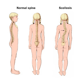 http://toshhospitals.com/spine-surgery/spinal-fusion/