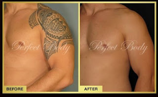 Bizzyaski Tattoo Tattoo Removal Piercing And Laser Studio Abuja Best Tattoo Removal Studio In Abuja Nigeria