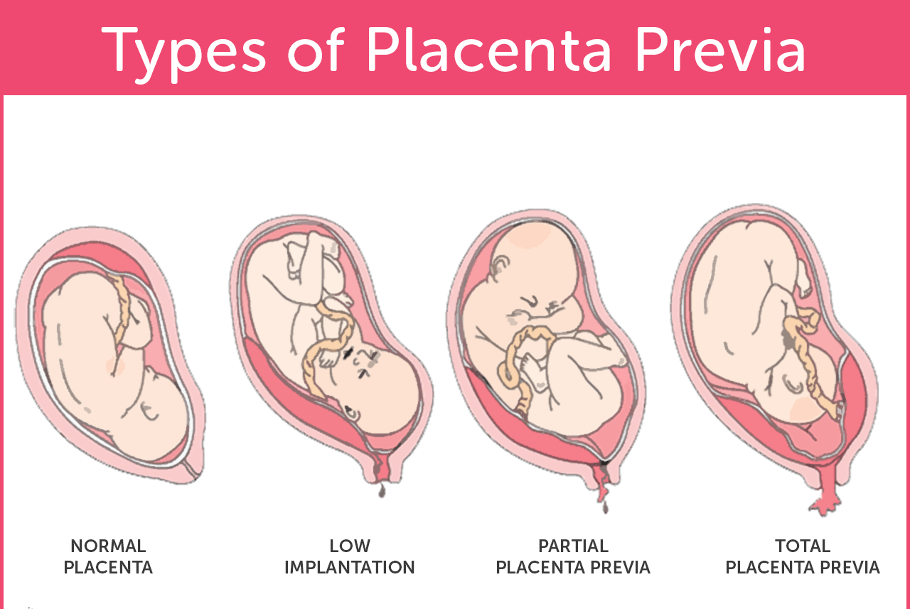 cephalic presentation during low lying placenta