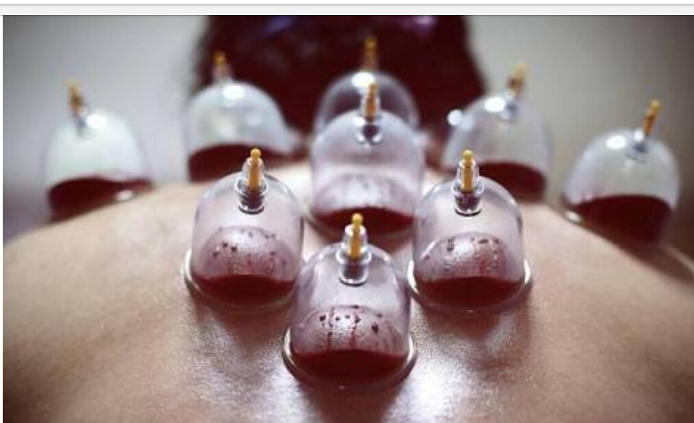 Healing Touch Hijama Cupping