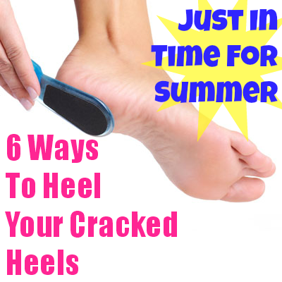 6 Ways To Heal Your Cracked Heels Just In Time For Summer